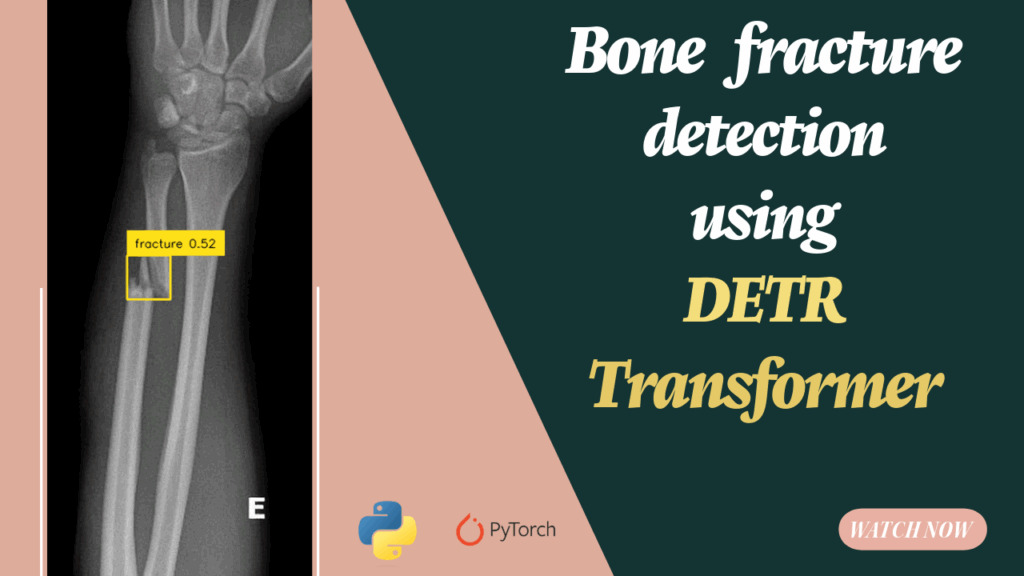 Detr for Smart Bone Fracture Detection