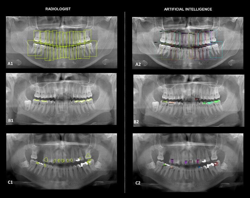 Teeth Detection using Yolo V8
